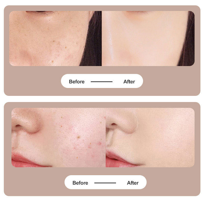 Avelena | Plasma-Pen-Laser zur Tattoo- und Muttermalentfernung