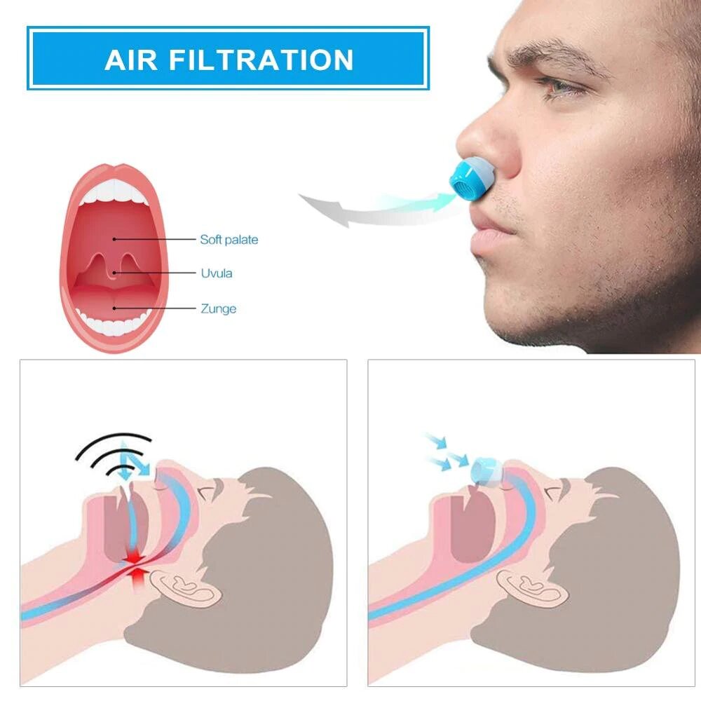 Avelena | Anti-Schnarch-Gerät | Schlauchloses, maskenloses Mikro-CPAP
