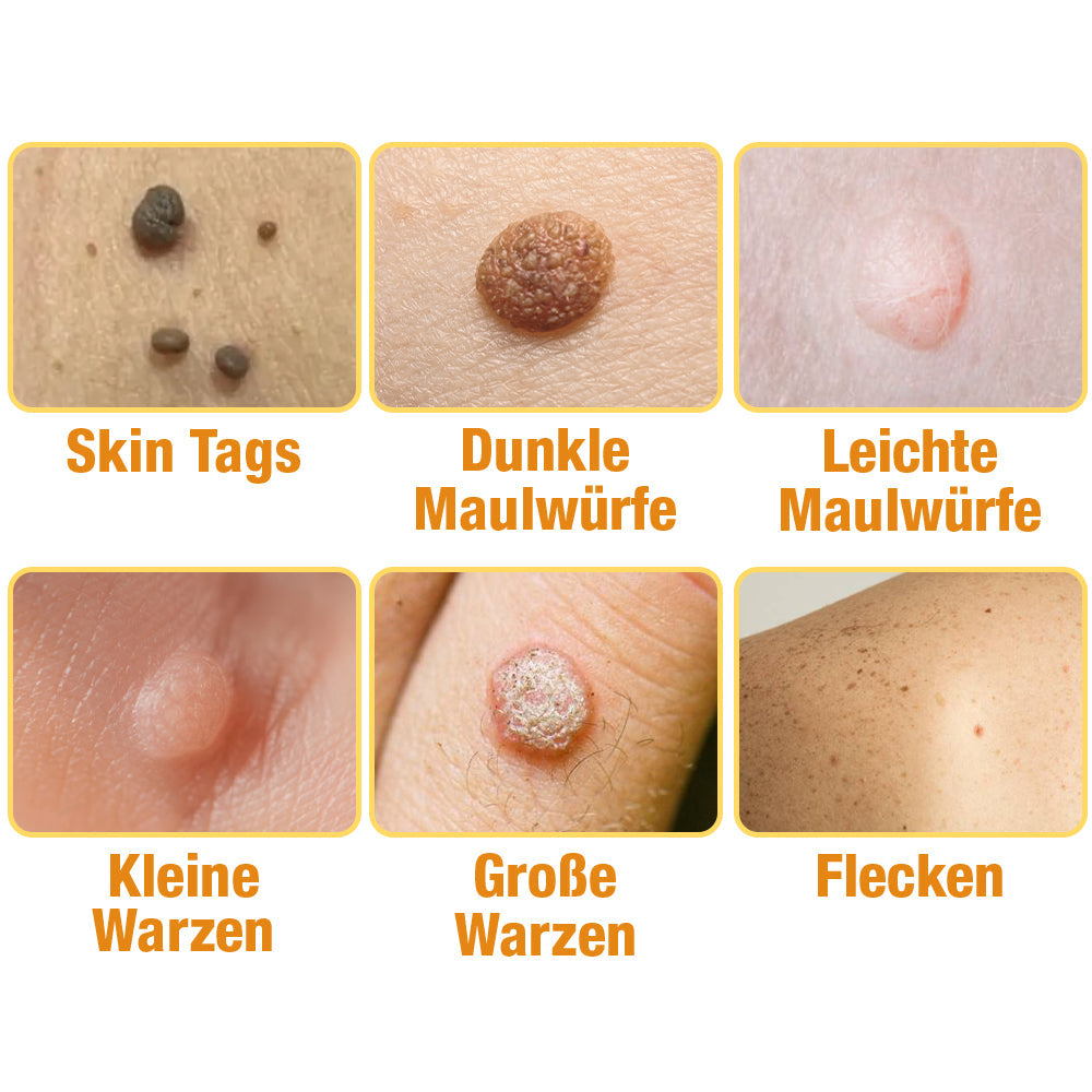 Avelena | Warzenentfernungsspray | Hauttag & Muttermal Pflege | Bienengift-Formel für sanfte Hautreinigung