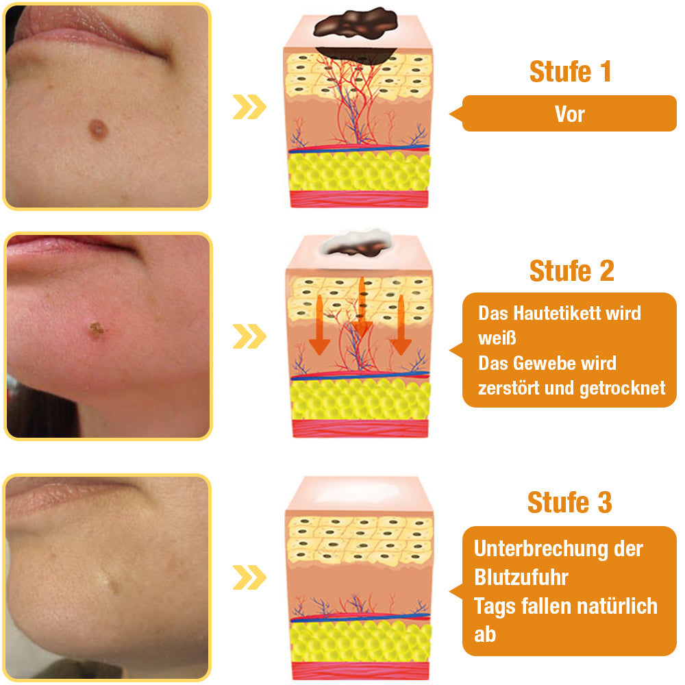 Avelena | Warzenentfernungsspray | Hauttag & Muttermal Pflege | Bienengift-Formel für sanfte Hautreinigung