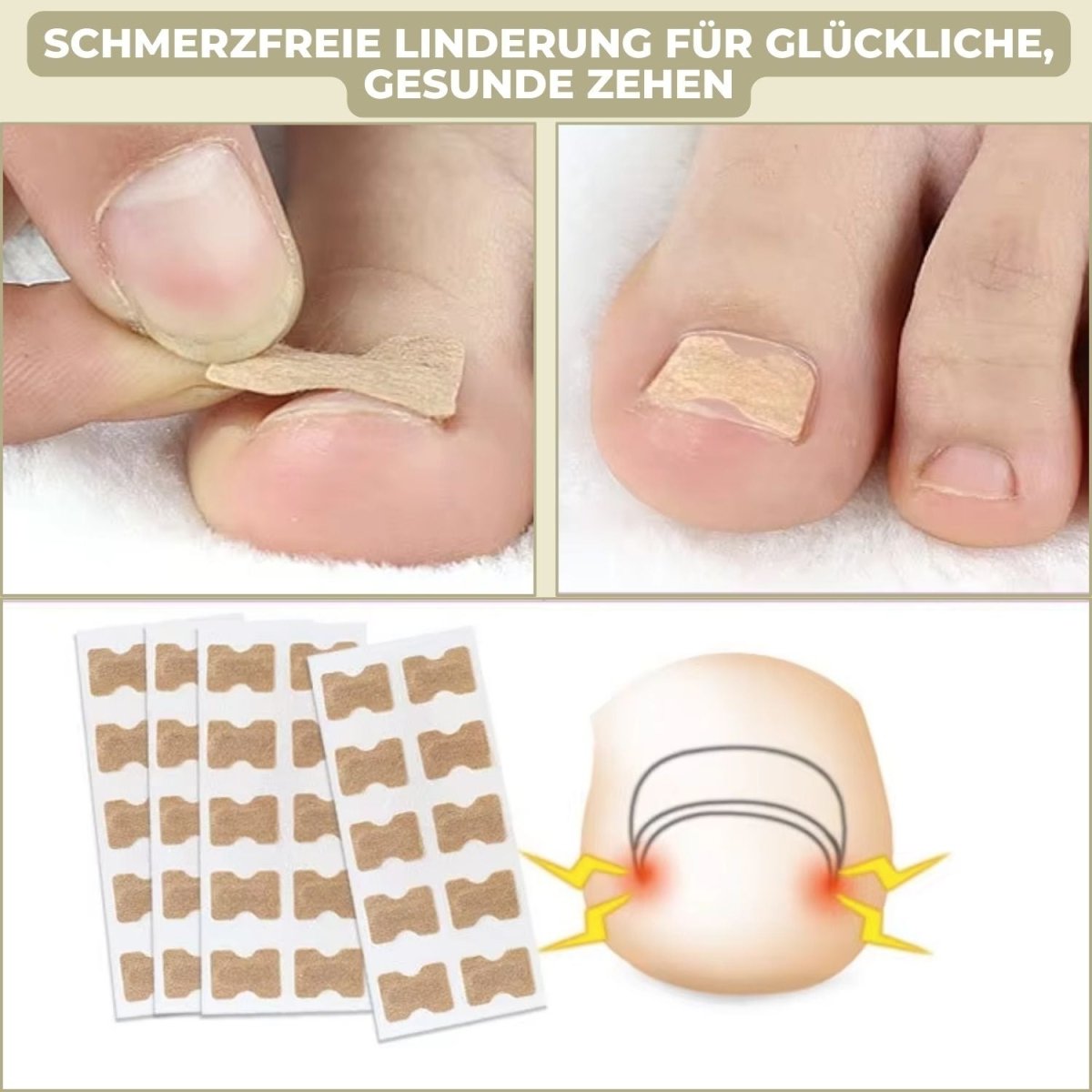 Avelena | ALIGNSTRIP – Schmerzfreie Nagelkorrekturstreifen für eingewachsene und deformierte Nägel