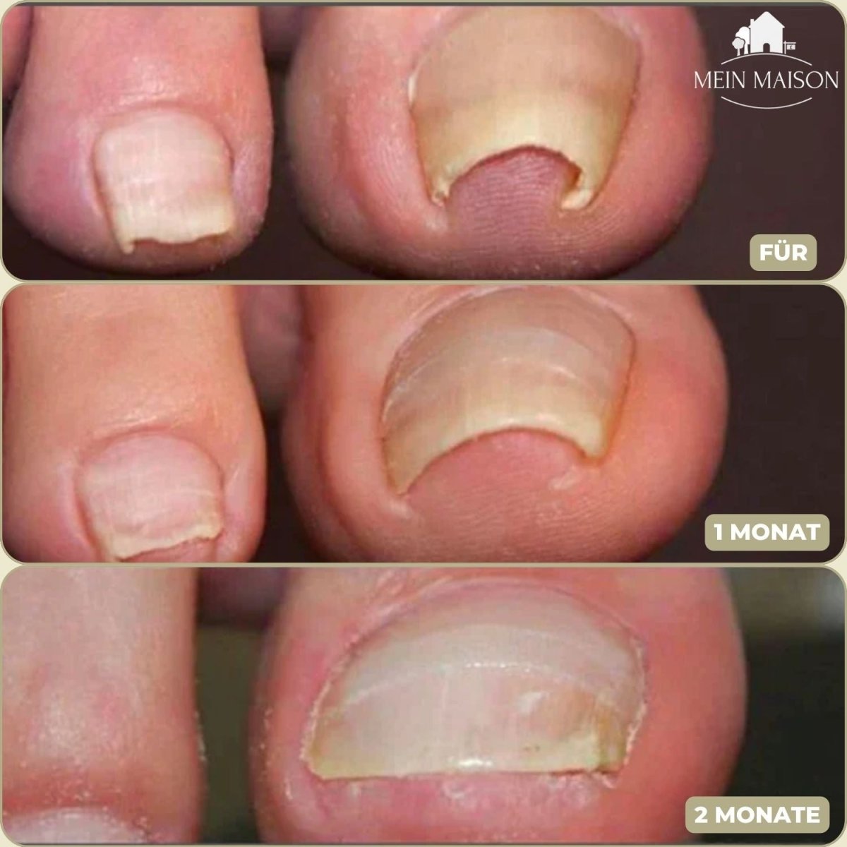 Avelena | ALIGNSTRIP – Schmerzfreie Nagelkorrekturstreifen für eingewachsene und deformierte Nägel