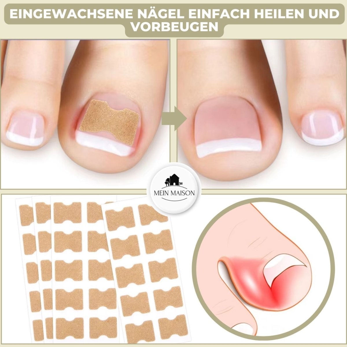 Avelena | ALIGNSTRIP – Schmerzfreie Nagelkorrekturstreifen für eingewachsene und deformierte Nägel
