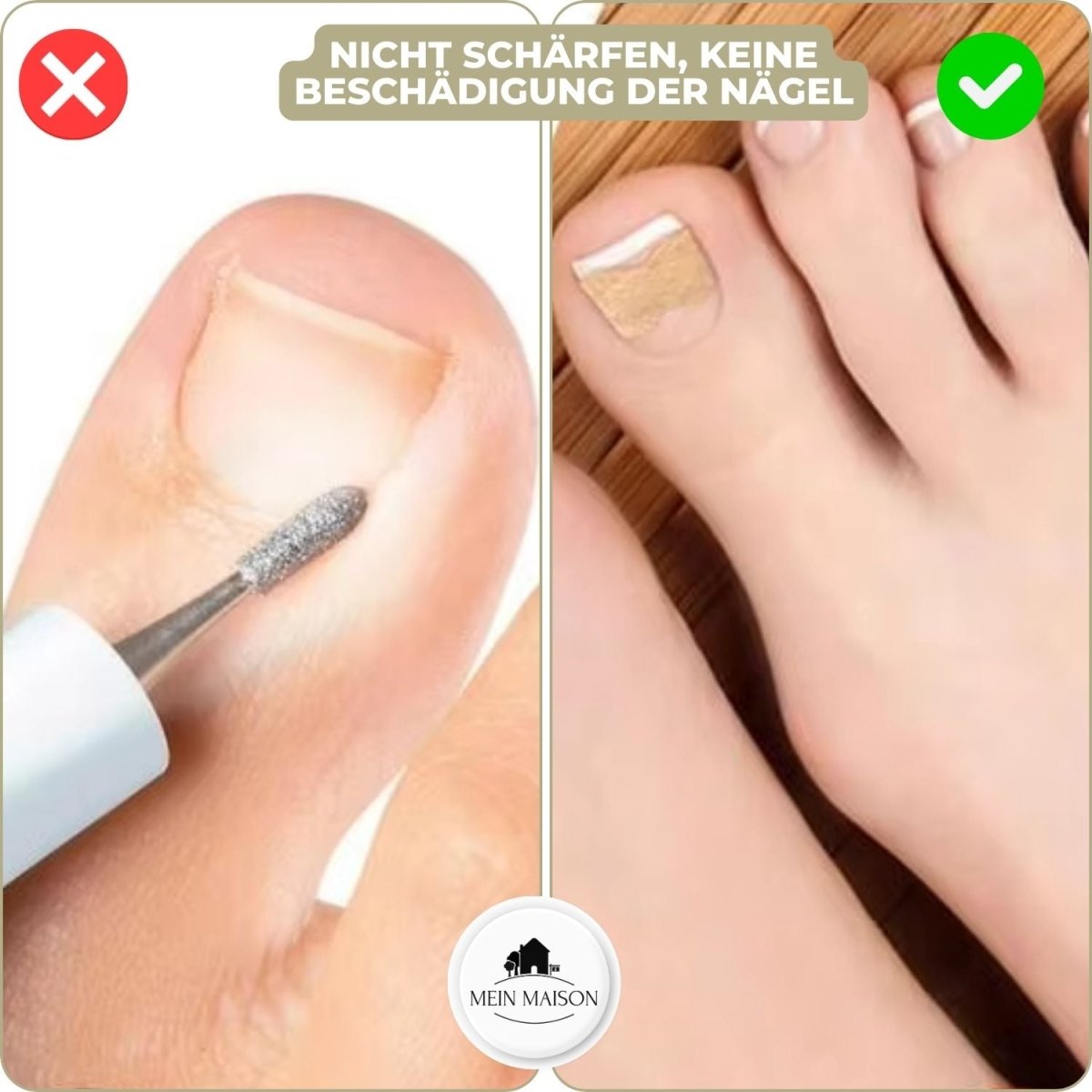 Avelena | ALIGNSTRIP – Schmerzfreie Nagelkorrekturstreifen für eingewachsene und deformierte Nägel