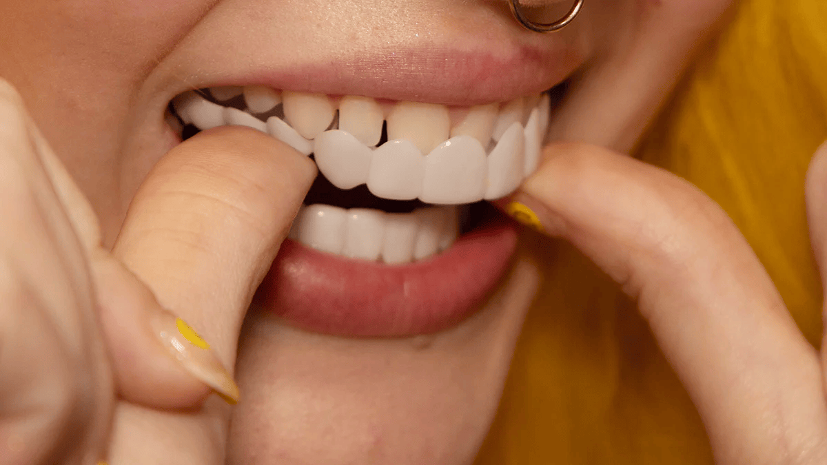 Avelena | Sofortige Lächelverwandlung mit Snap on Smile Veneers