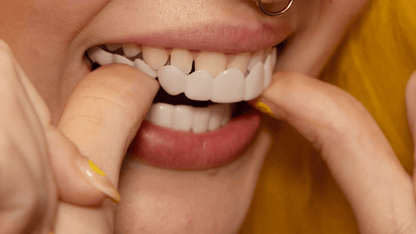 Avelena | Sofortige Lächelverwandlung mit Snap on Smile Veneers