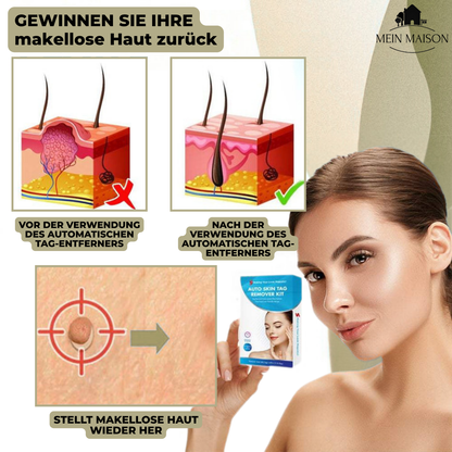 Avelena | Clarina SkinClear | Warzen- & Muttermalentferner | Sanft & Effektiv | Für Gesicht & Körper