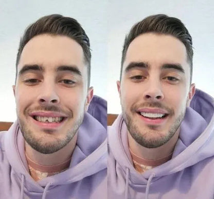 Avelena | On Smile Veneers Set | Temporäre Zahnverschönerung | Ober- & Unterkiefer