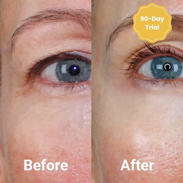 Avelena | DermaFaden Vollständiges Kollagen-Fadenlifting-Kit