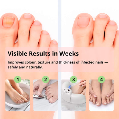 Avelena | ClearToe | Nagelbehandlung – Gesündere und schönere Nägel schnell