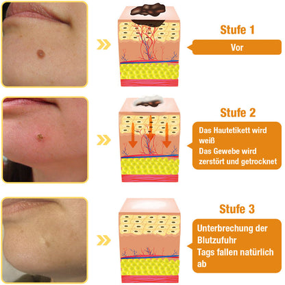 Avelena | Warzenentfernungsspray | Hauttag & Muttermal Pflege | Bienengift-Formel für sanfte Hautreinigung