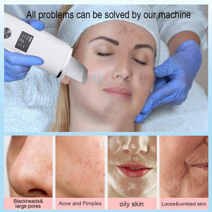 Avelena | Ultraschall Gesichts Scrubber Peeling Werkzeug