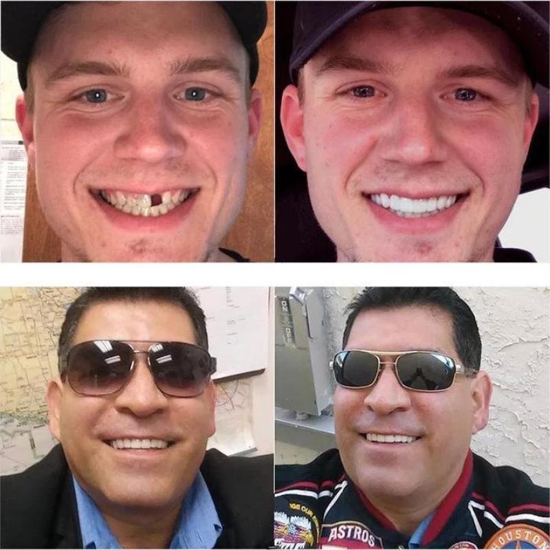 Avelena | Snap-On-Prothesen