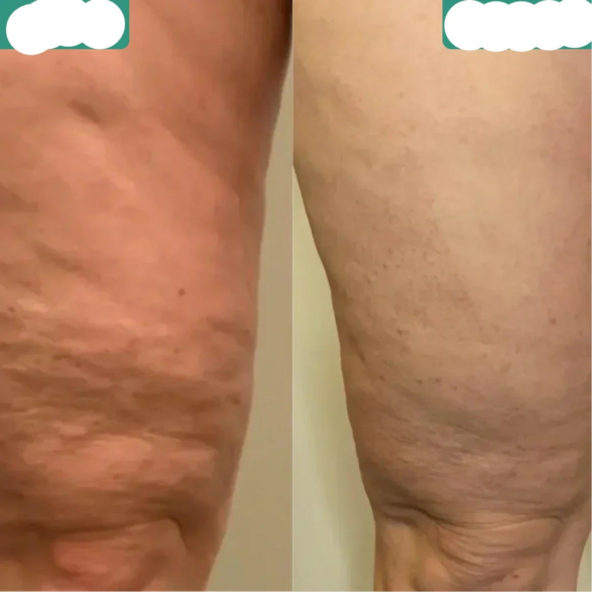Avelena | Effektive Cellulite-Reduktion und Hautglättung