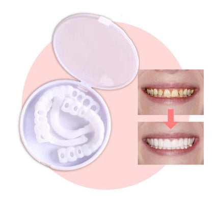 Avelena | Smilesnap Immer das perfekte Lächeln mit diesen Veneers