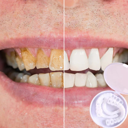 Avelena | Smilesnap Immer das perfekte Lächeln mit diesen Veneers